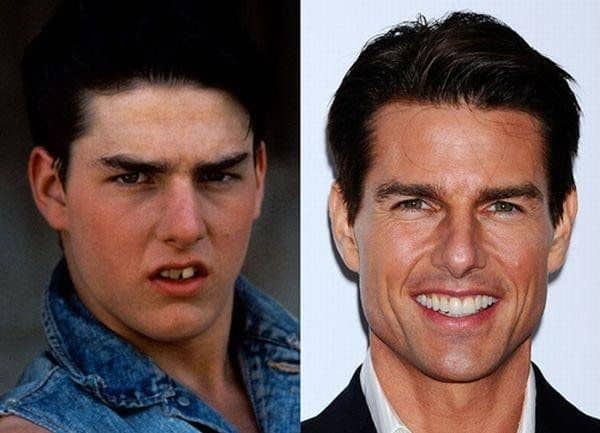 Tom cruise's teeth before and after photos and dental procedure
